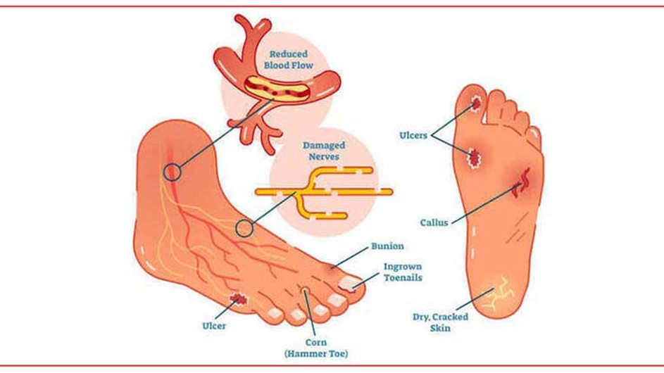 ডায়াবেটিস রোগীদের পায়ের যত্নে করণীয়