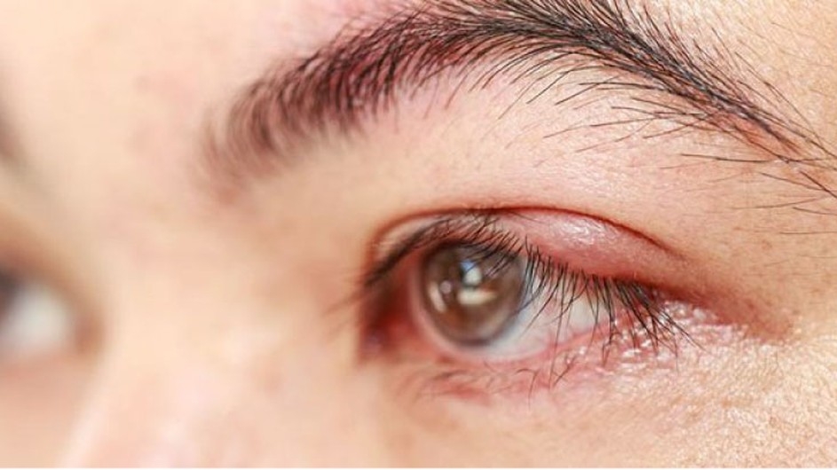 হঠাৎ বাড়ছে চোখ ওঠা রোগী, যা বলছেন বিশেষজ্ঞরা