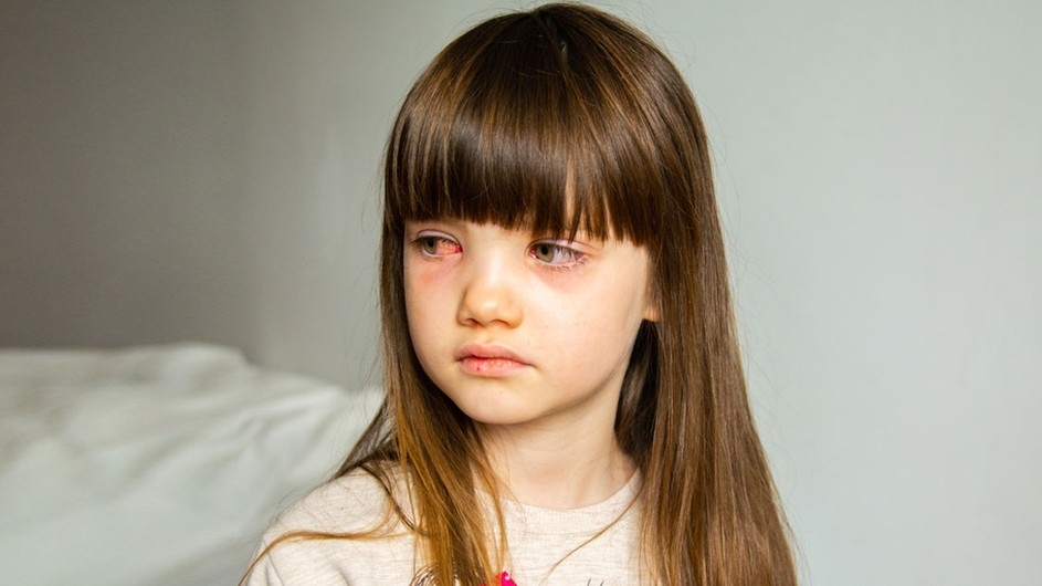 চোখ ওঠা সমস্যায় যেসব খাবার উপকারী