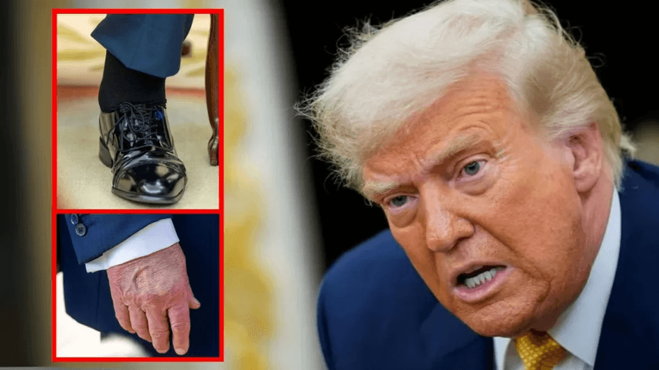 ট্রাম্পের পা ফোলা, হাতে কালশিটে দাগ— ধরা পড়েছে ধমনীর জটিলতা