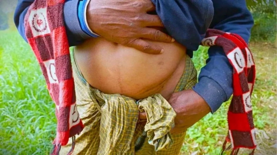 বাংলাদেশে ‘এক কিডনির গ্রাম’,