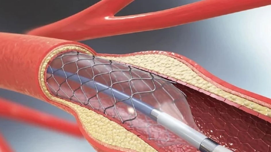 হার্টের রিং-এর দাম কমালো সরকার