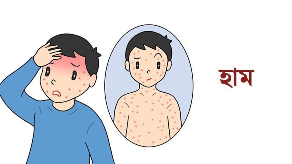 হামের ঊর্ধ্বগতি রোধে কমিউনিটি স্বাস্থ্যসেবা জোরদারের পরামর্শ বিশেষজ্ঞদের