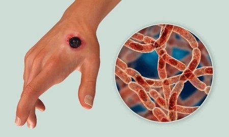 অ্যানথ্রাক্স প্রতিরোধে রংপুর বিভাগে ৩০ লাখ টিকা সরবরাহ করবে এলআরআই