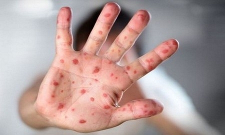 হাম ও হামের উপসর্গ নিয়ে আরও ৯ শিশুর মৃত্যু