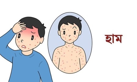 হামের ঊর্ধ্বগতি রোধে কমিউনিটি স্বাস্থ্যসেবা জোরদারের পরামর্শ বিশেষজ্ঞদের